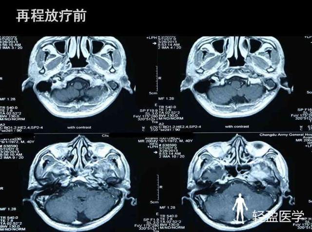 你离鼻咽癌还有多远?来了解下鼻咽癌吧!经典案例