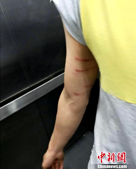 班主任杜某的手被打伤。钟欣 摄 吴平华 摄 班主任杜某的手被打伤。钟欣 摄 吴平华 摄