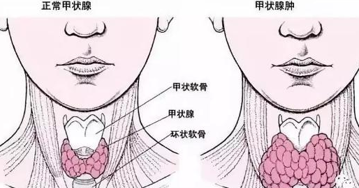 代理人让隐瞒甲减买保险 桥本甲状腺炎平安保险