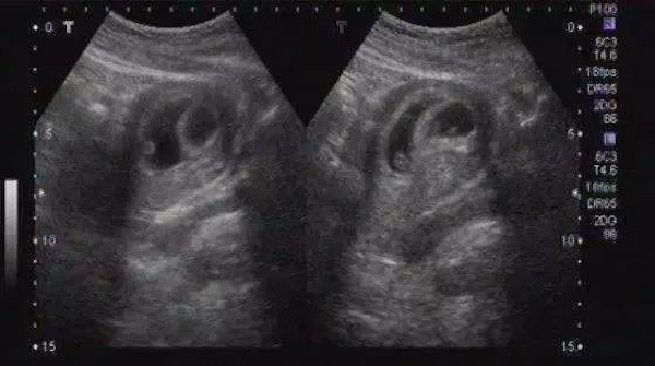 辟谣｜怀孕50天，超声看孕囊能看出男女？