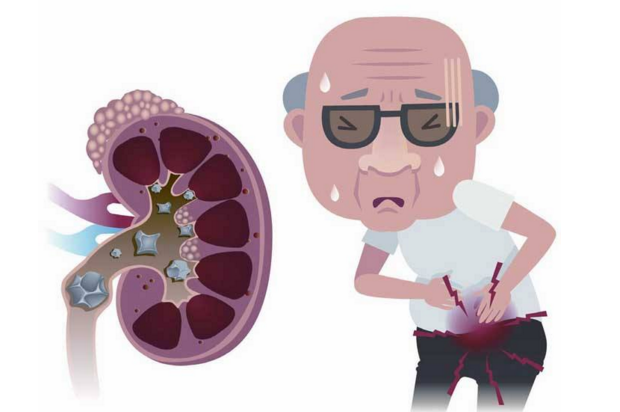 结石痛起来要人命,别怕!这些饮食细节要注意