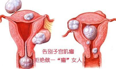 最常见的妇科疾病——子宫肌瘤的治疗只能开刀拿掉吗?