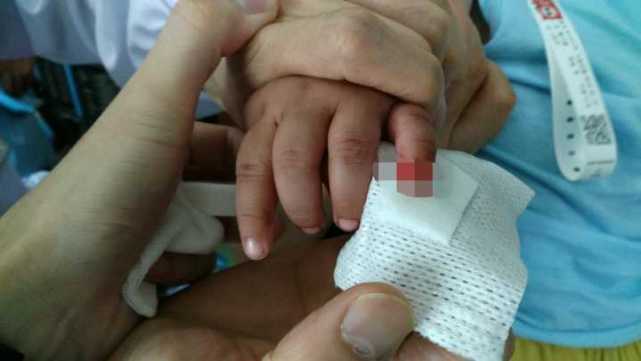 亲戚想给小孩修剪衣服 不慎剪断11个月男婴小手指