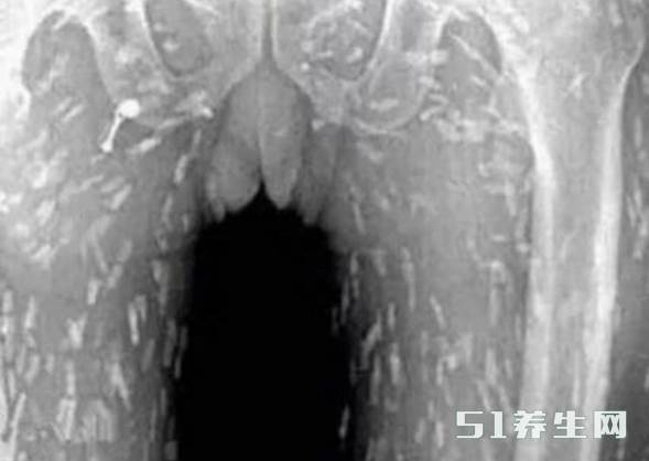 女人吃完生鱼片后,全身瘙痒到医院检查后,医生