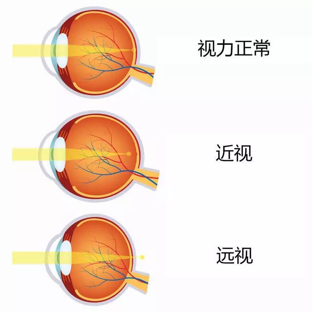 近视眼就不怕老花了?想得美,只要活得久,人人能拥有