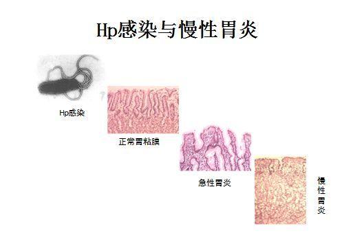幽门螺杆菌根除治疗,用药多长时间最合适?