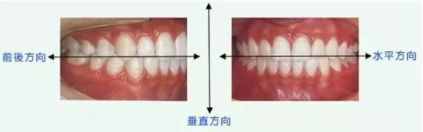 可以通过牙齿矫正改善嘴型 进而改善脸型 牙齿咬合不正 当你闭嘴的