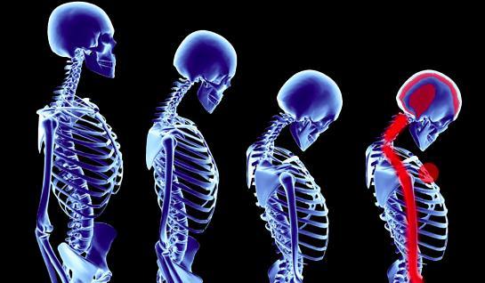 颈椎病注意事项