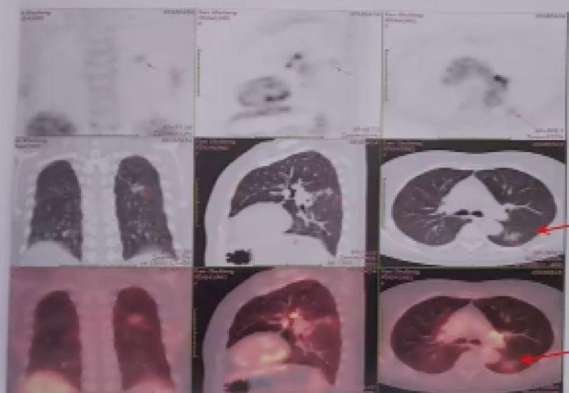 肺癌病例∣一例双肺原发性癌的病例讨论