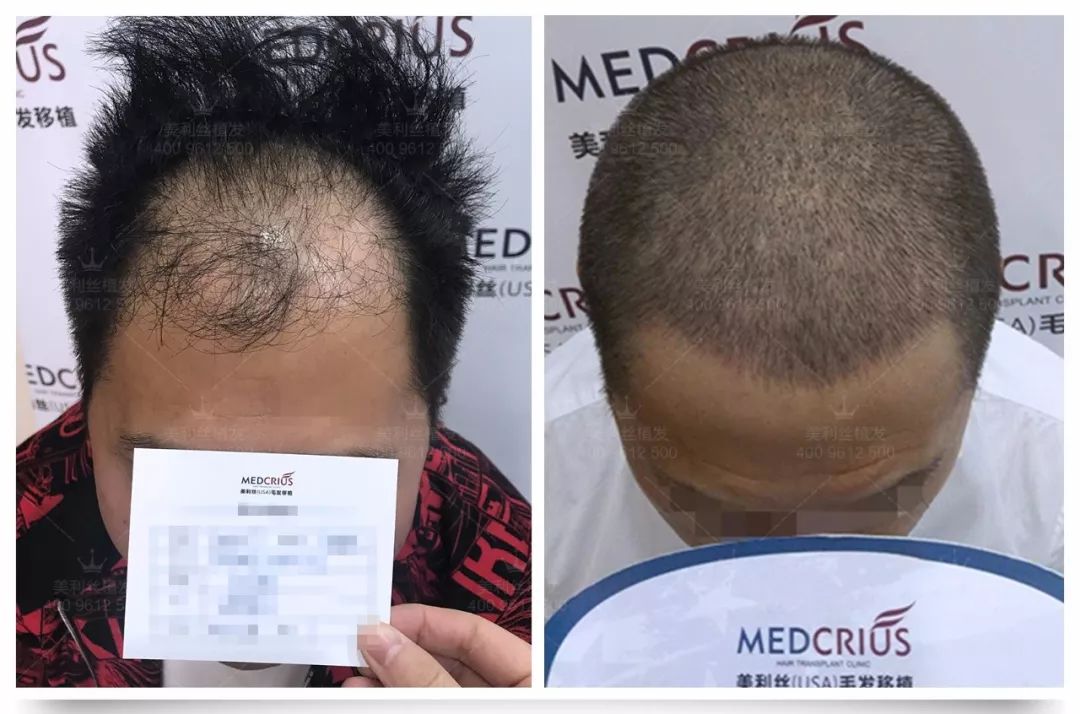 每天掉多少根头发算正常?超过了是病理性脱发