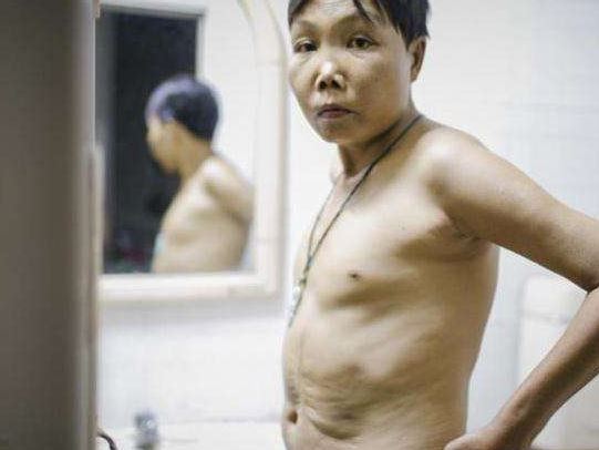 当并发含铁血黄素沉着症时