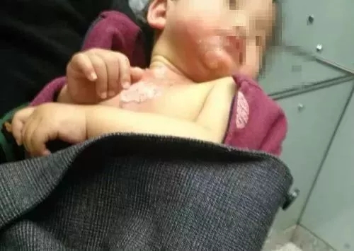 男婴被100℃洗澡水烫伤！妈妈的急救连医生都点赞！