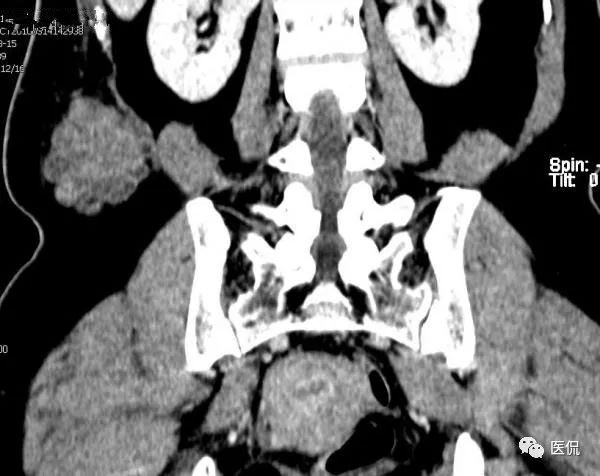 中年女性患者,腰部长了个包,这个影像病例有点难诊断!