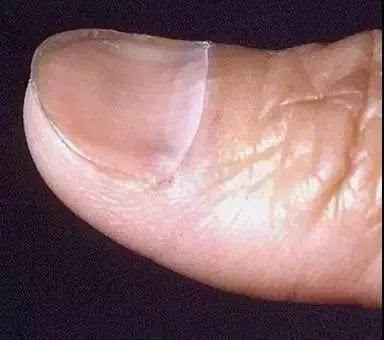 指甲上有黑线竟是癌症前兆?出现这8种指甲情