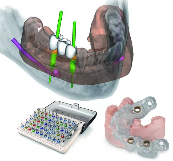 数字化3D导板精准种植牙技术发布会7月28日举