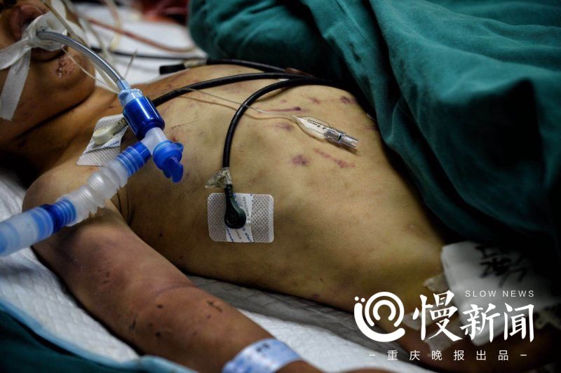 重庆5岁男童疑遭奶奶长期毒打：浑身伤痕住进ICU至今昏迷