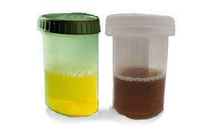 襄阳6岁女孩排出茶色尿!夏季这种运动要适量