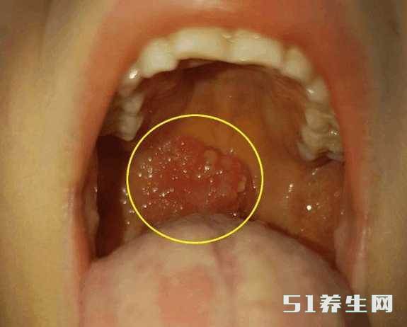 喉咙里面居然长了"石头",使劲咳了下,咳出来一阵