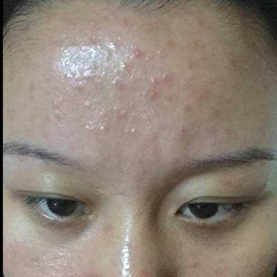 科学护肤讲堂:油性敏感肌肤该如何护肤