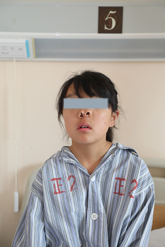 “三鼻孔”女孩16年来靠嘴呼吸，上海医生为其完成矫形手术