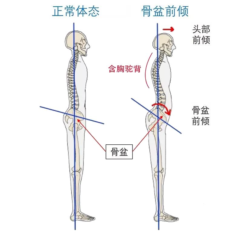 盆骨前倾是一种非常常见的现象,又称下交叉综合症,造成下交叉综合症是