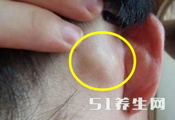 淋巴结都有其效劳的区域,当其管辖的区域内呈现炎症时,它才会肿大。 淋巴结都有其效劳的区域,当其管辖的区域内呈现炎症时,它才会肿大。