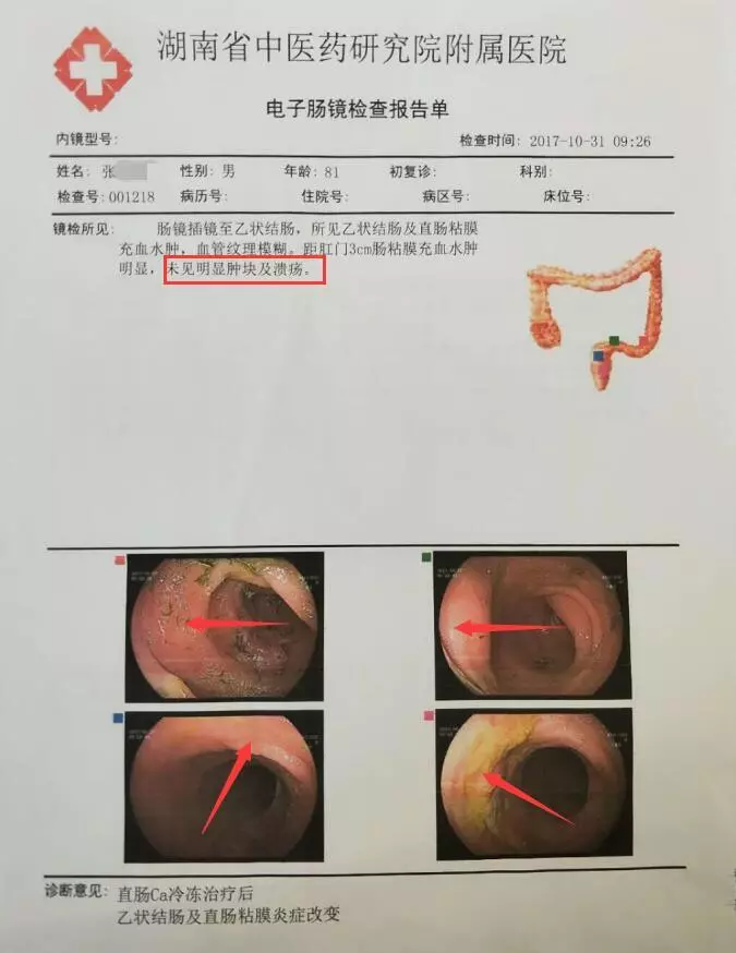 低位直肠癌患者冷冻保肛术后一年半追踪报告