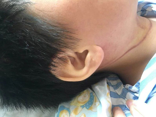 杭州12岁男孩脚下一滑，被床边绳套勒住脖子险些丧命