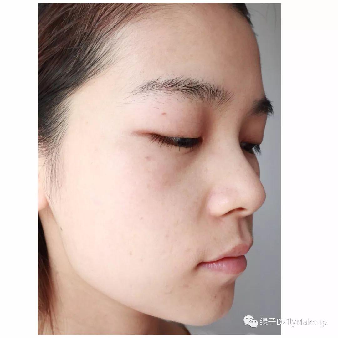 素颜相见 | 光子嫩肤+激光祛斑,效果究竟怎么样