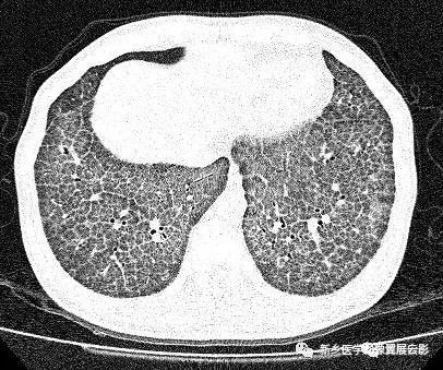 注意这6种肺部疾病:症状体征与影像学表现不符
