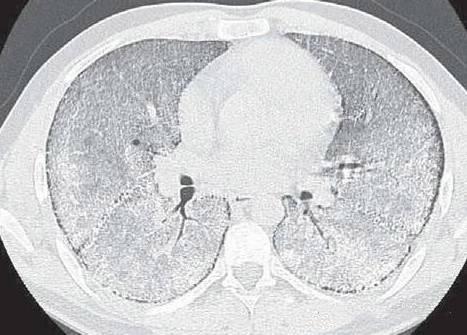 注意这6种肺部疾病:症状体征与影像学表现不符