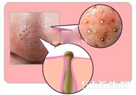 鼻子上的黑头像“韭菜”拔了又长，教你一招再顽固的黑头都不怕!
