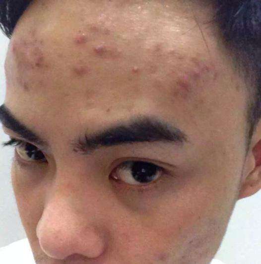螨虫患者注意: 脸上出现3个皮肤问题, 不要忽视