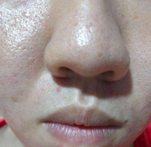 螨虫患者注意: 脸上出现3个皮肤问题, 不要忽视