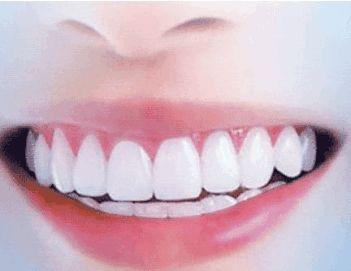 误区四:洗牙后牙齿会变白