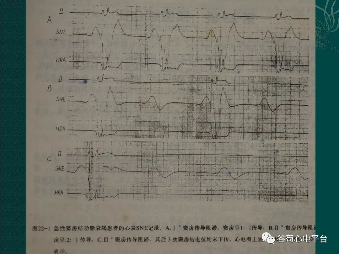 病态窦房结综合征