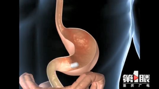 智博会抢先看 | AI胶囊机器人 告别肠胃镜检查的