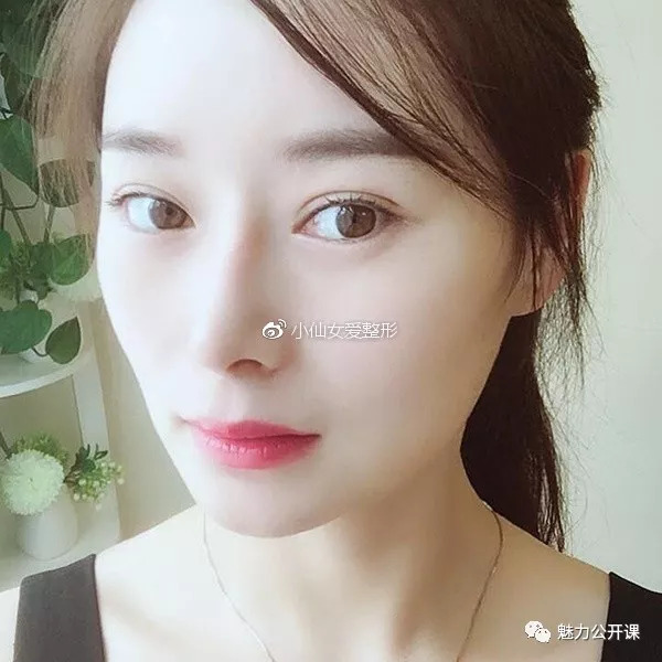 苏州肋软骨隆鼻整形日记:鼻头还在持续消肿中