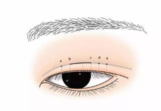 全切双眼皮多长时间能恢复 双眼皮消肿吃什么