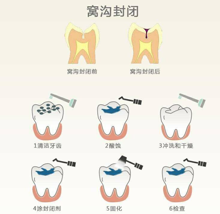 给宝宝做窝沟封闭的4个最佳时机,会让宝宝远离蛀牙!