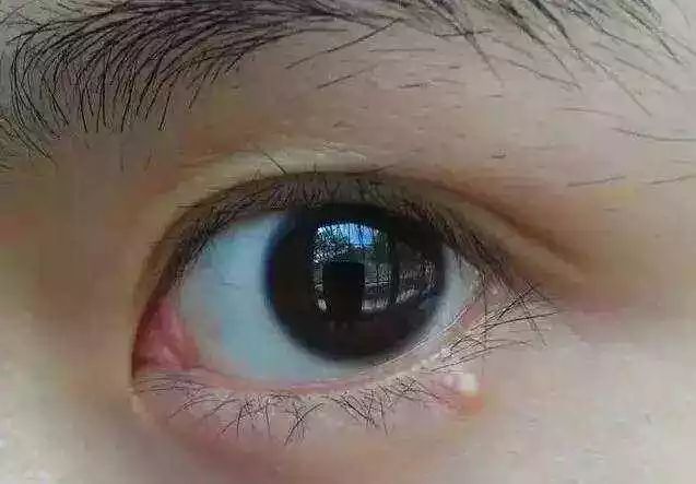 比痘痘还让人绝望的脂肪粒和丝状疣!用它竟然