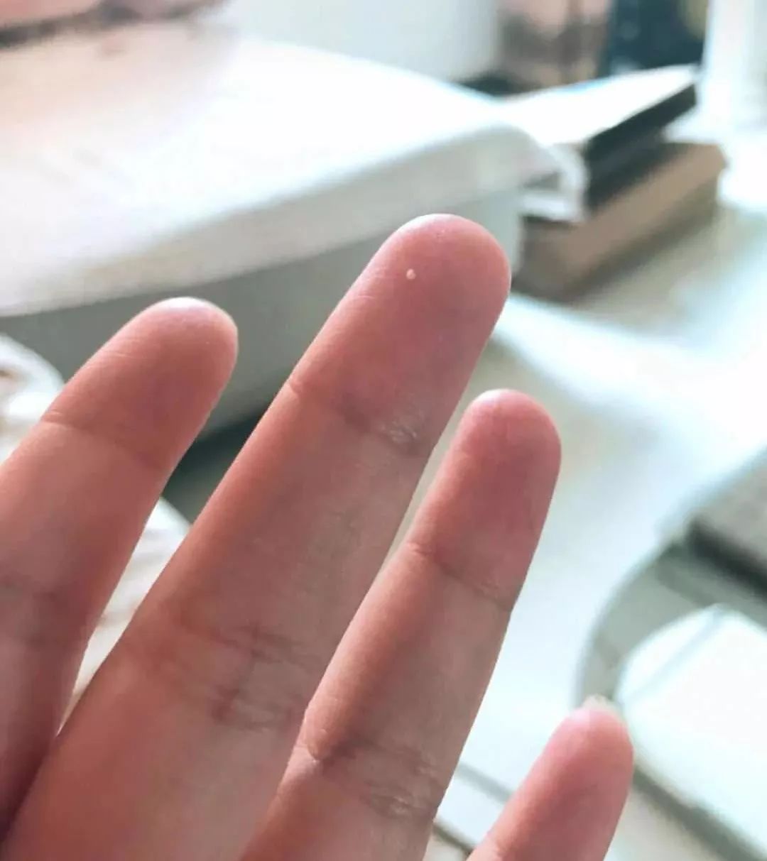 比痘痘还让人绝望的脂肪粒和丝状疣!用它竟然