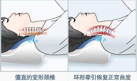 颈椎生理曲度变直那么可怕,你真的不考虑纠正