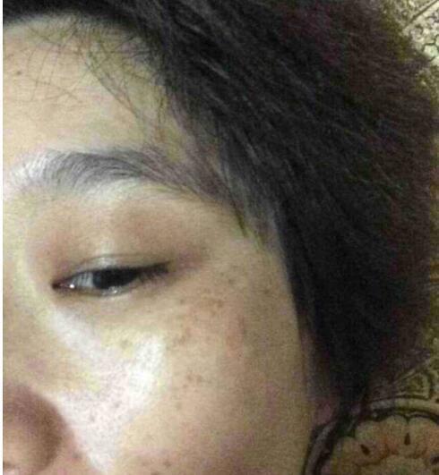 当海鱼皮碰上维C,就成了治疗黄褐斑的克星,快