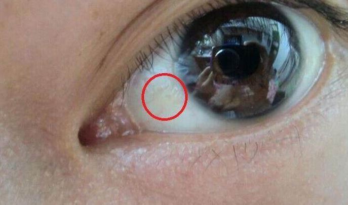 经毛细血管流经全身,就出现黄染现象,而眼球巩膜发黄就是主要特征之一