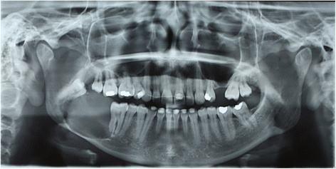 坏牙不拔会导致骨髓炎?