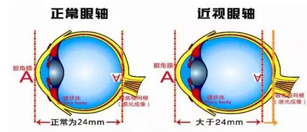 长期戴框架眼镜会不会诱发眼球凸出？眼球变形还能恢复吗？