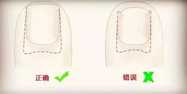 指甲创伤容易感染灰指甲