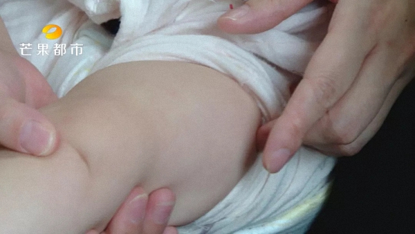 五个月大女婴被误注射脊灰活病毒 湖南卫计委调查