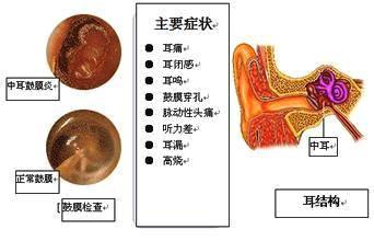 耳道"出水"流脓就是中耳炎吗?